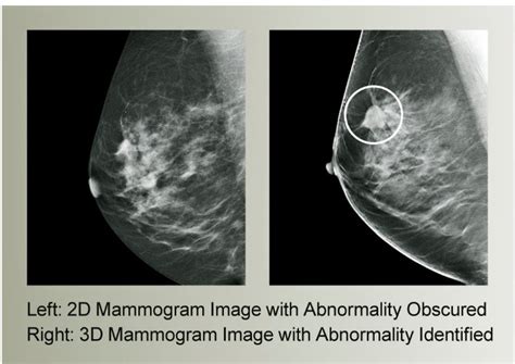 the villages breast cancer mammogram